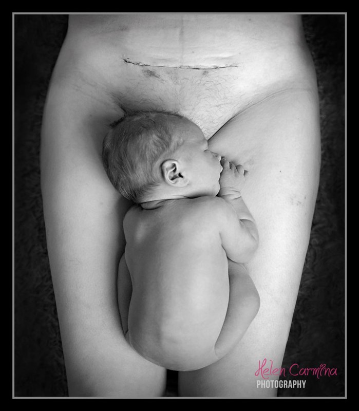 More than 11.5 million people have seen this beautiful c-section scar photo